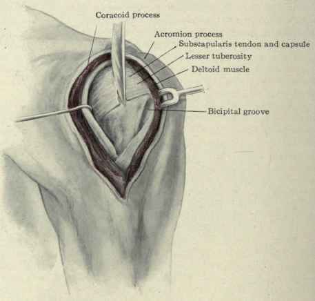 Fig. 265. Resection of the shoulder joint. The arm has been rotated outward so as to put the tendon of the subscapularis on the stretch. The long tendon of the biceps has been dislocated from the bicipital groove and is held to the inner side by a hook.