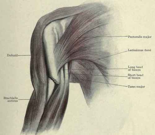 Fig. 289.   Fracture of the shaft of the humerus just above the insertion of the deltoid and below the insertion of the axillary fold muscles. The lower fragment is seen to be drawn outward by the deltoid; the upper fragment is seen to be drawn inward by the pectoralis major, latissimus dorsi, and teres major.