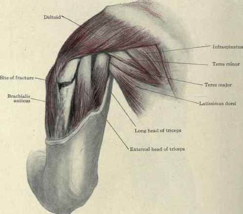 Fig. 290.   Posterior view of a fracture of the shaft of the humerus just below the insertion of the deltoid, showing the influence of that muscle in producing abduction of the upper fragment.