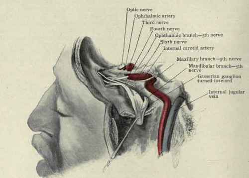 Fig. 30.   The internal carotid artery in its course through the skull, showing its relations to the jugular vein and cranial nerves. The Gasserian ganglion has been raised from its bed and turned forward.