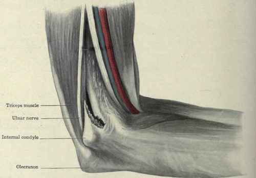 Fig. 311.   Transverse fracture of the lower end of the humerus above the condyles. The upper fragmen is seen to be displaced forward and the lower fragment with the olecranon is displaced backward. This posterio displacement is increased by tension of the triceps muscle.