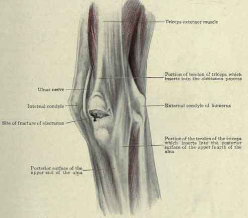Fig. 314.   Fracture of the olecranon process, showing the insertion of the triceps muscle into the olecranon and upper fourth of the ulna.
