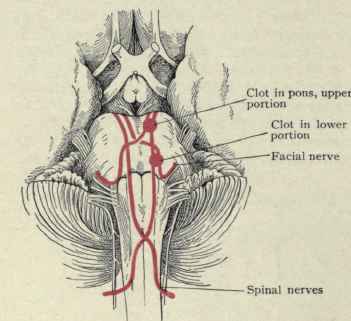 Fig. 39. Diagram illustrative of crossed paralysis. A clot in the upper portion of the pons causes paralysis of the muscles of the face and extremities of the same side of the body. A clot in the lower portion of the pons causes paralysis of one side of the face and the extremities of the opposite side of the body.
