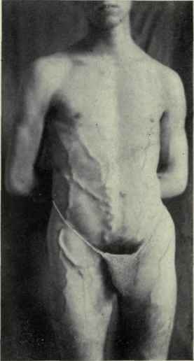 Fig. 392.   Obstruction of the right iliac vein from phlebitis. The vena thoracica epigastrica longa is seen running from the groin up to the axilla.