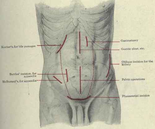 Fig. 393. Incisions for abdominal operations.