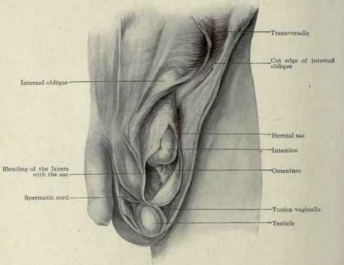 Fig. 397.   The coverings of an acquired oblique inguinal hernia; from an actual dissection. The external and internal oblique have been divided along Poupart's ligament and turned inward exposing the transversalis.