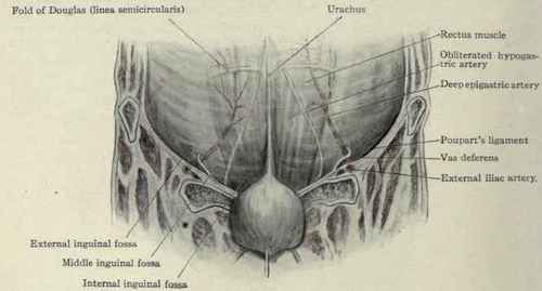 Fig. 399.   View of the posterior surface of the abdominal walls, showing the inguinal fossae and triangle of Hesselbach (the latter in red).