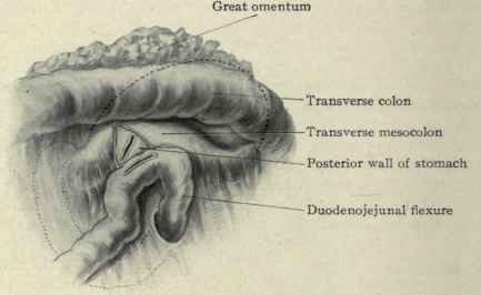 Fig. 418.   Posterior gastroenterostomy. The omentum and colon have been turned up and the two openings shown in the stomach and commencement of jejunum are to be sewn together along their edges, thus establishing a communication between the stomach and small intestine.