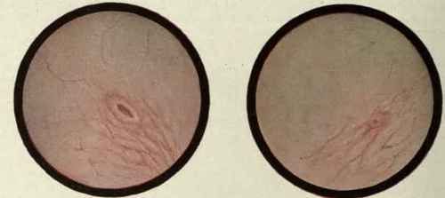 Fig. 453.   The picture on the left demonstrates a normal mucous membrane and ureteral orifice. On the right the ureteral orifice will be observed to be small, round, atrophic, and functionless. (Drawn from a case of Dr. Benj. A. Thomas* by Mr. Louis Schmidt).