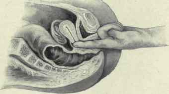 Fig. 462.   Digital vaginal examination. Ovary slightly prolapsed but as yet has not descended entirely into Douglas's pouch.