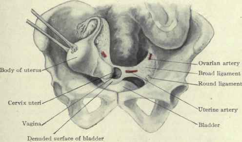 Fig. 464.   Removal of the entire uterus.