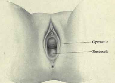 Fig,. 466.   Hernia of the bladder (cystocele) and of the rectum (rectocele).