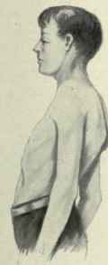 Fig. 479.   Kyphosis or angular anteroposterior curvature, usually due to caries of the bodies of the vertebras.
