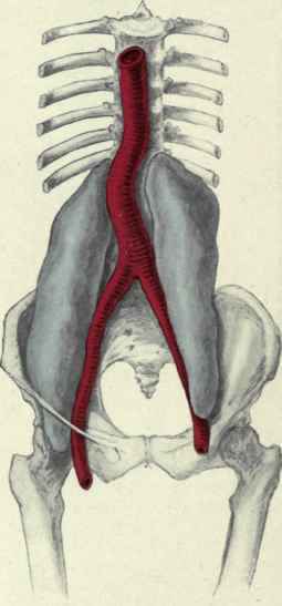 Fig. 482.   Psoas abscess originating from spinal caries of the dorsolumbar vertebra and following the psoas muscle to the groin. (From a sketch by the author of a specimen in the Mutter Museum of the College of Physicians).