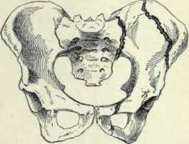 Fig. 493.   Diagram illustrating fracture of the pelvis; one fracture is seen passing through the ilium; the other passes through the sacro iliac articulation posteriorly and the thyroid foramen anteriorly.