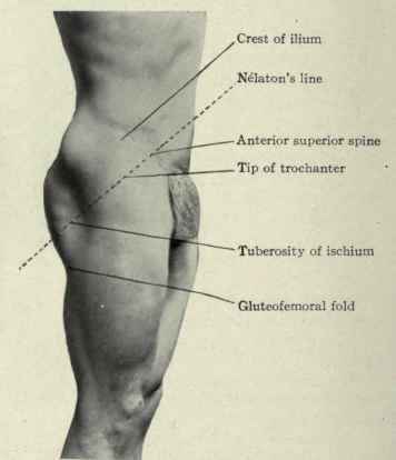Fig. 506.   Surface anatomy of the region of the hip.