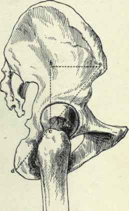 Fig. 507.   View of the outer surface of the bones of the hip showing Roser Nelaton line (a d). Bryant's triangle (a b c), iliotrochanteric line, (a c) and the iliotrochanteric angle (b a c).