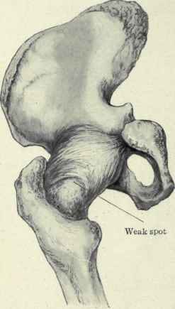 Fig. 510.   The ischiofemoral or posterior y ligament. The stem of the Y is attached at the base of the tuberosity of the ischium and one branch is seen going toward the greater trochanter and the other toward the lesser, leaving a weak spot between them half way down the neck of the bone.