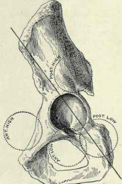 Fig. 513.   Diagram illustrating the position of the head in high and low dislocations on the anterior and posterior planes.