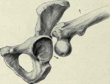 Fig. 514.   Luxation of the hip by indirect or leverage action. The shaft of the femur, from the greater trochanter out. is the long arm of the lever, the head and neck form the short arm and the upper edge of the acetabulum and ilium immediately above is the fulcrum. When the femur is abducted the head is lifted out of its socket rupturing the capsular ligament.