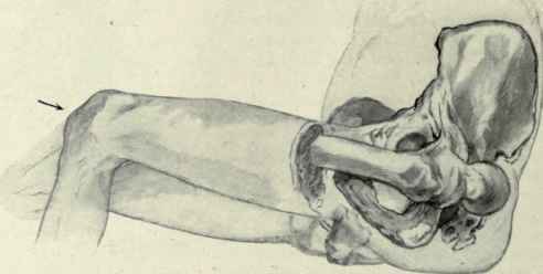 Fig. 515.   Posterior luxation of the hip produced by rotation and direct thrust. The femur is seen to be flexed on the pelvis, adducted and rotated inward; a thrust in the direction of the arrow then sends the head out of the acetabulum onto the posterior plane.
