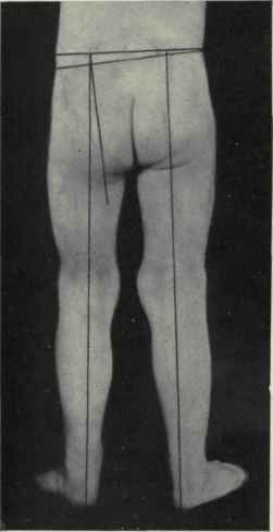 Fig. 525.   Early stage of coxalgia, showing the affected left limb abducted, thus lowering the pelvis on that side; slightly flexed, thus obliterating the glu teofemoral fold, and slightly everted.