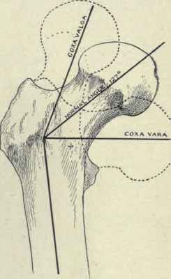 Fig. 526.   Normal angle of the head and neck to the shaft of the femur with the alteration in position in coxa valga and coxa vara shown by dotted lines.