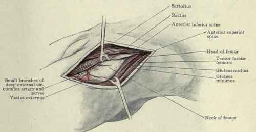 Fig. 528. Anterior operation on the hip joint.