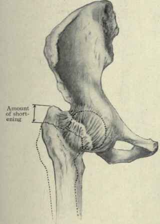 Fig. 538.   Intracapsular fracture of the neck of the femur showing the shortening. The dotted line represents the outline of the normal bone.