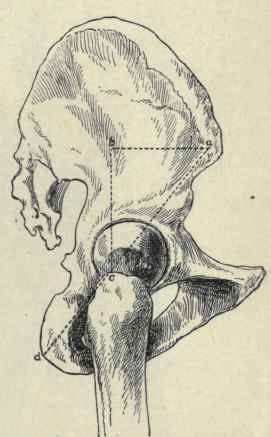 Fig. 539.   View of the outer surface of the bones of the hip. showing Roser Nelaton line (a d); Bryant's triangle (a b c   b c being its base); the iliotrochanteric line (a c) and iliotrochanteric angle (bac).