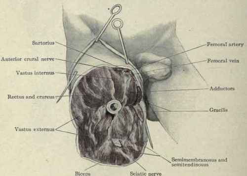Fig. 542.   Amputation just above the middle of the thigh, showing insertion of Wyeth's pins.