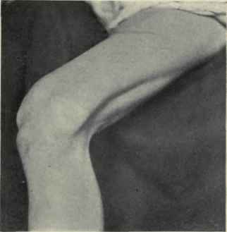 Fig. 552.   Dislocation of patella outward.