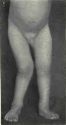 Fig. 555. Knock knee or genu valgum.