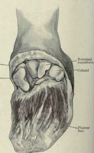Fig. 593.   Lisfranc's tarsometatarsal amputation of the foot.