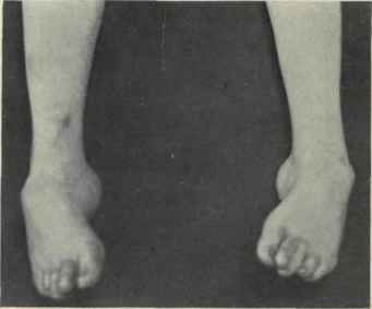 Fig. 595    Talipes equinovarus.