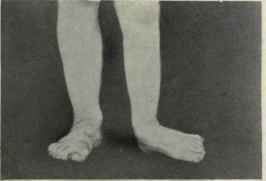 Fig. 596.   Paralytic talipes valgus.