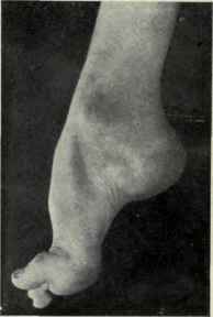 Fig. 598.   Talipes equinus.