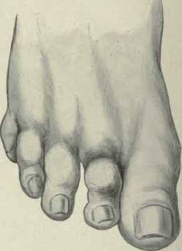 Fig. 603. Dorsal luxation of the proximal phalanx of the second toe. Notice the shortening of the toe, its separation from the third toe. and the fulness over the head of the metatarsal bone. (From a sketch by the author).