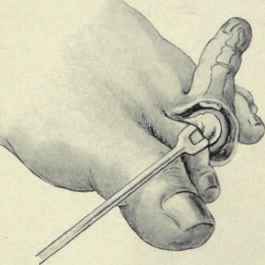 Fig. 604. Amputation of a toe at the metatarsophalangeal joint, with lateral flaps, showing method of disarticulating.