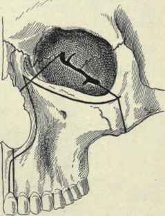 Fig. 64.   Resection of the upper jaw. The curved lines indicate the skin incision and the straight lines where the bones are to be divided.