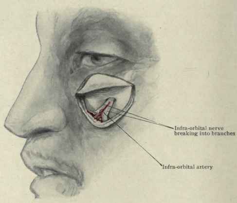 Fig. 65.   Exposure of the infra orbital nerve and artery.