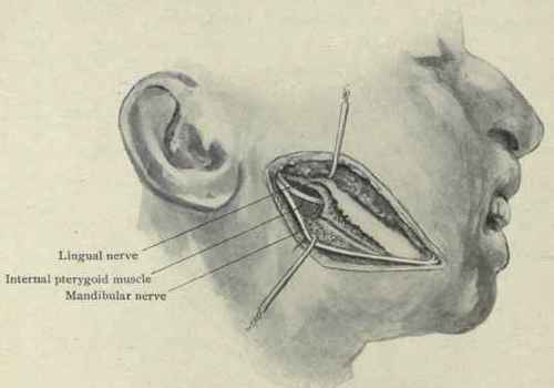 Fig. 68. Excision of the lingual and mandibular (inferior dental) nerves.
