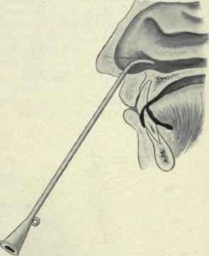 FlG. 152.   Introducing the Eustachian catheter, first step.