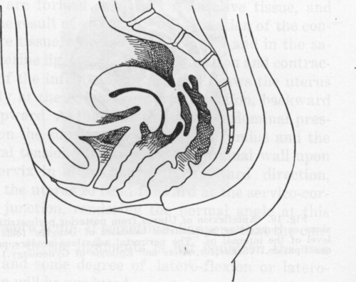 Fig. 18. Anteflexion Caused by Adhesions.