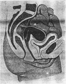 Fig. 19. Anteflexion of Uterus from posterior perimetritic adhesions or contracting parametritic exudates of Douglas' folds at the level of the internal os. The perirectal adhesions produce pain and constipation. (Schaeffer, Atlas and Epitome of Gynecology.)