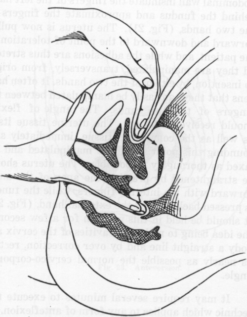 Fig. 22. Straightening an Anteflexion.