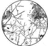 A Blackish Pellicle found in the Gastric Contenta (of T. M     ) alter a Test Breakfast.