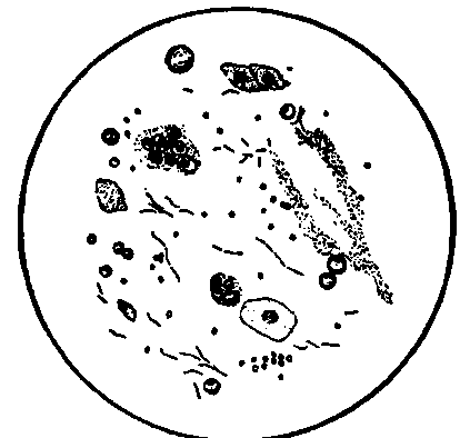 A Specimen of Mucus from the (Esophagus (from a Patient with Carcinoma Cardiae, J. C. W.).