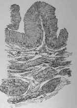 Cross section of a Bengin Hypertrophied Pylorus.