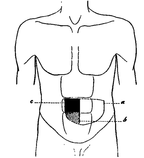 Result of Gastrodlaphany in Patient K.